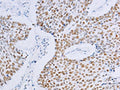 The image on the left is immunohistochemistry of paraffin-embedded Human lung cancer tissue using CSB-PA578532(MCM2 Antibody) at dilution 1/20, on the right is treated with fusion protein. (Original magnification: ×200)
