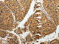 The image on the left is immunohistochemistry of paraffin-embedded Human liver cancer tissue using CSB-PA578648(RRM1 Antibody) at dilution 1/15, on the right is treated with fusion protein. (Original magnification: ×200)