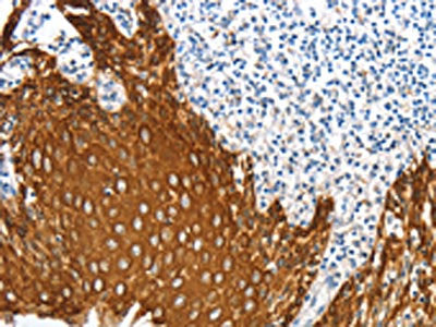 The image on the left is immunohistochemistry of paraffin-embedded Human tonsil tissue using CSB-PA579076(ANXA9 Antibody) at dilution 1/20, on the right is treated with fusion protein. (Original magnification: ×200)