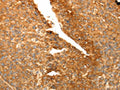 The image on the left is immunohistochemistry of paraffin-embedded Human liver cancer tissue using CSB-PA579193(SPATA2L Antibody) at dilution 1/30, on the right is treated with fusion protein. (Original magnification: ×200)