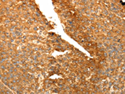 The image on the left is immunohistochemistry of paraffin-embedded Human liver cancer tissue using CSB-PA579193(SPATA2L Antibody) at dilution 1/30, on the right is treated with fusion protein. (Original magnification: ×200)