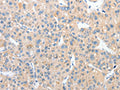 The image on the left is immunohistochemistry of paraffin-embedded Human liver cancer tissue using CSB-PA579544(RPN1 Antibody) at dilution 1/25, on the right is treated with fusion protein. (Original magnification: ×200)