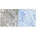 Immunohistochemistry analysis of paraffin-embedded human lung carcinoma tissue using SPINK6 antibody.