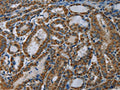 The image on the left is immunohistochemistry of paraffin-embedded Human thyroid cancer tissue using CSB-PA579687(NDUFA5 Antibody) at dilution 1/60, on the right is treated with fusion protein. (Original magnification: ×200)