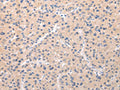 The image on the left is immunohistochemistry of paraffin-embedded Human liver cancer tissue using CSB-PA579827(ABCC1 Antibody) at dilution 1/20, on the right is treated with synthetic peptide. (Original magnification: ×200)