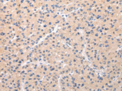 The image on the left is immunohistochemistry of paraffin-embedded Human liver cancer tissue using CSB-PA579827(ABCC1 Antibody) at dilution 1/20, on the right is treated with synthetic peptide. (Original magnification: ×200)