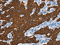 The image is immunohistochemistry of paraffin-embedded Human gastic cancer tissue using CSB-PA579932(KRT8 Antibody) at dilution 1/20. (Original magnification: ×200)