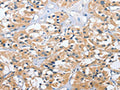 The image on the left is immunohistochemistry of paraffin-embedded Human thyroid cancer tissue using CSB-PA579990(UGCG Antibody) at dilution 1/40, on the right is treated with fusion protein. (Original magnification: ×200)