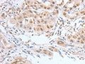 The image on the left is immunohistochemistry of paraffin-embedded Human lung cancer tissue using CSB-PA580508(ATF2 Antibody) at dilution 1/15, on the right is treated with fusion protein. (Original magnification: ×200)