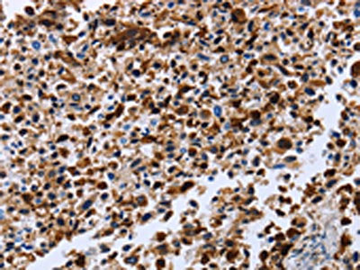 The image on the left is immunohistochemistry of paraffin-embedded Human lung cancer tissue using CSB-PA580658(CXCR3  Antibody) at dilution 1/20, on the right is treated with synthetic peptide. (Original magnification: ×200)