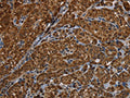 The image on the left is immunohistochemistry of paraffin-embedded Human thyroid cancer tissue using CSB-PA581084(HSD17B13 Antibody) at dilution 1/30, on the right is treated with fusion protein. (Original magnification: ×200)