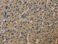 The image is immunohistochemistry of paraffin-embedded Human liver cancer tissue using CSB-PA581290(CORO1C Antibody) at dilution 1/60. (Original magnification: ×200)
