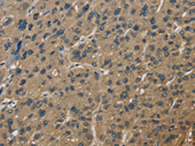 The image is immunohistochemistry of paraffin-embedded Human liver cancer tissue using CSB-PA581290(CORO1C Antibody) at dilution 1/60. (Original magnification: ×200)