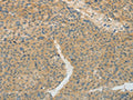 The image on the left is immunohistochemistry of paraffin-embedded Human liver cancer tissue using CSB-PA581368(TEKT5 Antibody) at dilution 1/20, on the right is treated with fusion protein. (Original magnification: ×200)