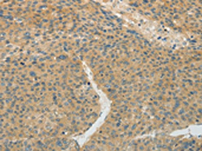 The image on the left is immunohistochemistry of paraffin-embedded Human liver cancer tissue using CSB-PA581368(TEKT5 Antibody) at dilution 1/20, on the right is treated with fusion protein. (Original magnification: ×200)