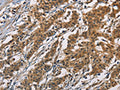 The image on the left is immunohistochemistry of paraffin-embedded Human gastic cancer tissue using CSB-PA581463(ATP2C1 Antibody) at dilution 1/60, on the right is treated with fusion protein. (Original magnification: ×200)