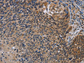 The image is immunohistochemistry of paraffin-embedded Human cervical cancer tissue using CSB-PA582088(STAT1 Antibody) at dilution 1/20. (Original magnification: ×200)