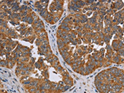 The image on the left is immunohistochemistry of paraffin-embedded Human ovarian cancer tissue using CSB-PA582168(ADAMTS15 Antibody) at dilution 1/60, on the right is treated with fusion protein. (Original magnification: ×200)