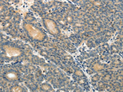The image on the left is immunohistochemistry of paraffin-embedded Human thyroid cancer tissue using CSB-PA582291(ABCC12 Antibody) at dilution 1/10, on the right is treated with synthetic peptide. (Original magnification: ×200)