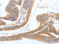 The image on the left is immunohistochemistry of paraffin-embedded Human colon cancer tissue using CSB-PA582653(TGFA Antibody) at dilution 1/60, on the right is treated with fusion protein. (Original magnification: ×200)