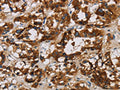 The image is immunohistochemistry of paraffin-embedded Human thyroid cancer tissue using CSB-PA582788(BCL2L12 Antibody) at dilution 1/20. (Original magnification: ×200)