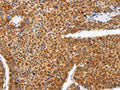 The image on the left is immunohistochemistry of paraffin-embedded Human liver cancer tissue using CSB-PA583273(SPATA13 Antibody) at dilution 1/25, on the right is treated with fusion protein. (Original magnification: ×200)