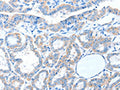The image on the left is immunohistochemistry of paraffin-embedded Human thyroid cancer tissue using CSB-PA583376(ADAM21 Antibody) at dilution 1/15, on the right is treated with fusion protein. (Original magnification: ×200)