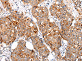 The image on the left is immunohistochemistry of paraffin-embedded Human breast cancer tissue using CSB-PA583379(MUC1(CT) Antibody) at dilution 1/20, on the right is treated with synthetic peptide. (Original magnification: ×200)