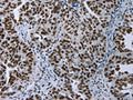 The image on the left is immunohistochemistry of paraffin-embedded Human ovarian cancer tissue using CSB-PA583825(ELN Antibody) at dilution 1/50, on the right is treated with fusion protein. (Original magnification: ×200)