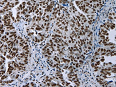 The image on the left is immunohistochemistry of paraffin-embedded Human ovarian cancer tissue using CSB-PA583825(ELN Antibody) at dilution 1/50, on the right is treated with fusion protein. (Original magnification: ×200)