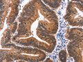 The image on the left is immunohistochemistry of paraffin-embedded Human colon cancer tissue using CSB-PA584061(MAPK13 Antibody) at dilution 1/15, on the right is treated with synthetic peptide. (Original magnification: ×200)