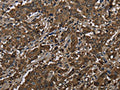 The image on the left is immunohistochemistry of paraffin-embedded Human liver cancer tissue using CSB-PA584245(GSTP1 Antibody) at dilution 1/60, on the right is treated with fusion protein. (Original magnification: ×200)