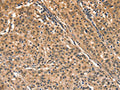 The image on the left is immunohistochemistry of paraffin-embedded Human gastic cancer tissue using CSB-PA584418(AIMP1 Antibody) at dilution 1/40, on the right is treated with synthetic peptide. (Original magnification: ×200)
