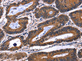 The image on the left is immunohistochemistry of paraffin-embedded Human colon cancer tissue using CSB-PA584603(IL1A Antibody) at dilution 1/60, on the right is treated with fusion protein. (Original magnification: ×200)