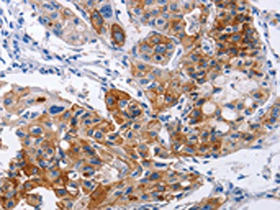 The image on the left is immunohistochemistry of paraffin-embedded Human lung cancer tissue using CSB-PA584826(ICAM1 Antibody) at dilution 1/30, on the right is treated with synthetic peptide. (Original magnification: ×200)