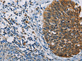 The image on the left is immunohistochemistry of paraffin-embedded Human tonsil tissue using CSB-PA584842(FXYD1 Antibody) at dilution 1/60, on the right is treated with fusion protein. (Original magnification: ×200)