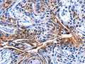 The image on the left is immunohistochemistry of paraffin-embedded Human esophagus cancer tissue using CSB-PA584850(CLCA4 Antibody) at dilution 1/15, on the right is treated with fusion protein. (Original magnification: ×200)