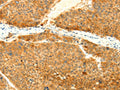 The image on the left is immunohistochemistry of paraffin-embedded Human liver cancer tissue using CSB-PA585168(SNAP25 Antibody) at dilution 1/25, on the right is treated with fusion protein. (Original magnification: ×200)