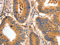 The image on the left is immunohistochemistry of paraffin-embedded Human colon cancer tissue using CSB-PA585175(BAIAP2 Antibody) at dilution 1/30, on the right is treated with fusion protein. (Original magnification: ×200)