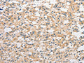 The image on the left is immunohistochemistry of paraffin-embedded Human thyroid cancer tissue using CSB-PA585936(TLR4 Antibody) at dilution 1/50, on the right is treated with fusion protein. (Original magnification: ×200)