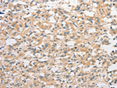 The image on the left is immunohistochemistry of paraffin-embedded Human thyroid cancer tissue using CSB-PA585936(TLR4 Antibody) at dilution 1/50, on the right is treated with fusion protein. (Original magnification: ×200)