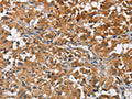 The image on the left is immunohistochemistry of paraffin-embedded Human thyroid cancer tissue using CSB-PA586126(ATP1B2 Antibody) at dilution 1/30, on the right is treated with fusion protein. (Original magnification: ×200)