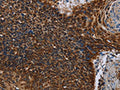 The image on the left is immunohistochemistry of paraffin-embedded Human cervical cancer tissue using CSB-PA586287(IDH2 Antibody) at dilution 1/60, on the right is treated with fusion protein. (Original magnification: ×200)