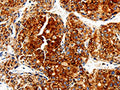 The image is immunohistochemistry of paraffin-embedded Human liver cancer tissue using CSB-PA586799(COX19 Antibody) at dilution 1/50. (Original magnification: ×200)