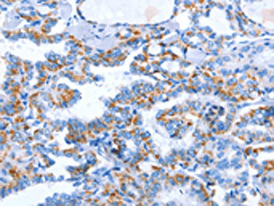 The image on the left is immunohistochemistry of paraffin-embedded Human thyroid cancer tissue using CSB-PA586979(WNT1 Antibody) at dilution 1/40, on the right is treated with synthetic peptide. (Original magnification: ×200)