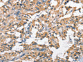 The image on the left is immunohistochemistry of paraffin-embedded Human thyroid cancer tissue using CSB-PA587075(SCARB1 Antibody) at dilution 1/60, on the right is treated with fusion protein. (Original magnification: ×200)