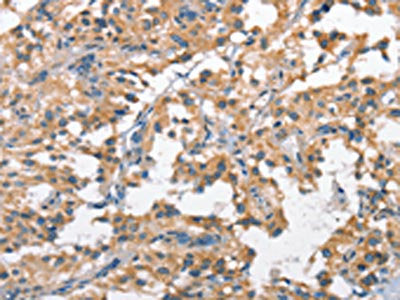 The image on the left is immunohistochemistry of paraffin-embedded Human thyroid cancer tissue using CSB-PA587075(SCARB1 Antibody) at dilution 1/60, on the right is treated with fusion protein. (Original magnification: ×200)
