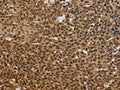 The image on the left is immunohistochemistry of paraffin-embedded Human cervical cancer tissue using CSB-PA587286(BRAF Antibody) at dilution 1/30, on the right is treated with synthetic peptide. (Original magnification: ×200)