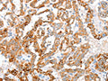 The image on the left is immunohistochemistry of paraffin-embedded Human thyroid cancer tissue using CSB-PA587551(ACY3 Antibody) at dilution 1/35, on the right is treated with fusion protein. (Original magnification: ×200)