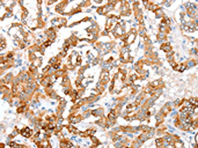 The image on the left is immunohistochemistry of paraffin-embedded Human thyroid cancer tissue using CSB-PA587551(ACY3 Antibody) at dilution 1/35, on the right is treated with fusion protein. (Original magnification: ×200)